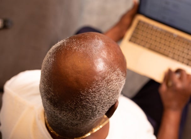 Bald men at greater risk of severe case of COVID-19, study claims